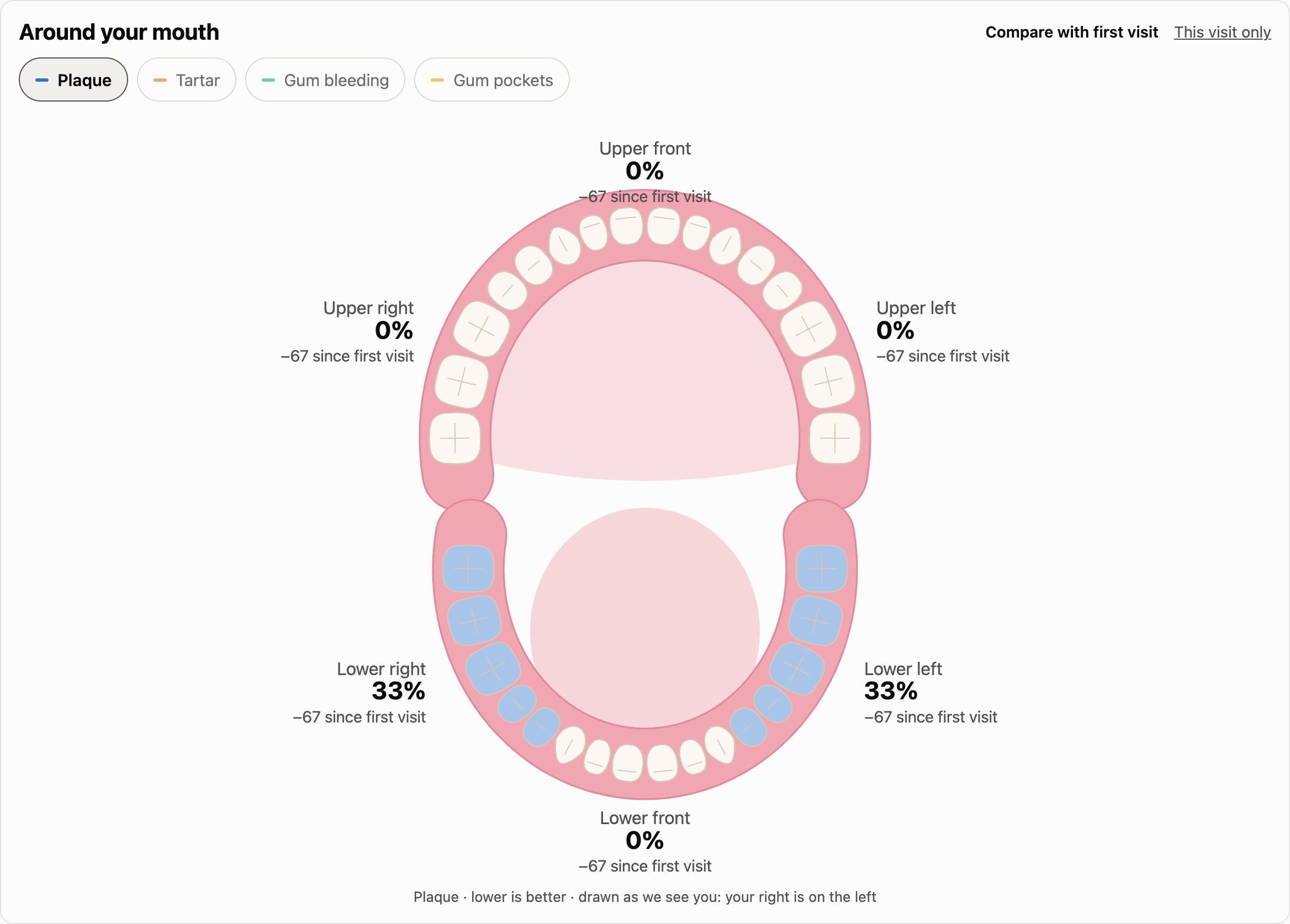 Illustrated mouth with all 32 teeth; the lower back teeth are tinted where plaque was found, with a percentage for each area
